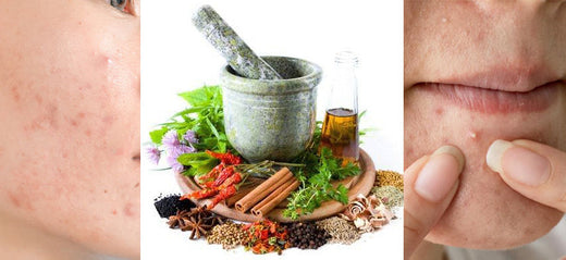 Skin Care: Acne Free Skin with Herbal Home Remedies